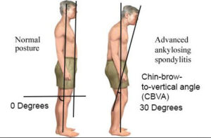 ankylosing-spondylitis-1